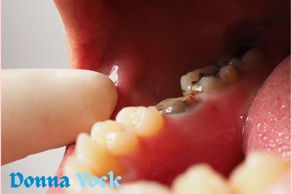 How to Determine Your Tooth Decay Risk