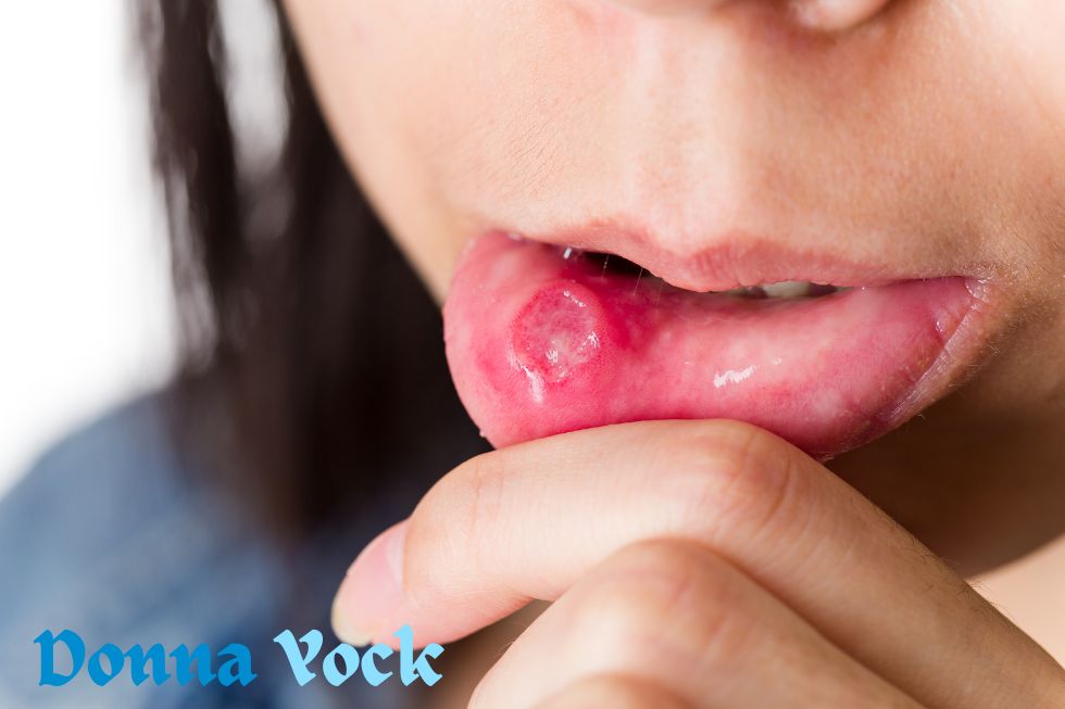 How to Naturally Remove Canker Sores