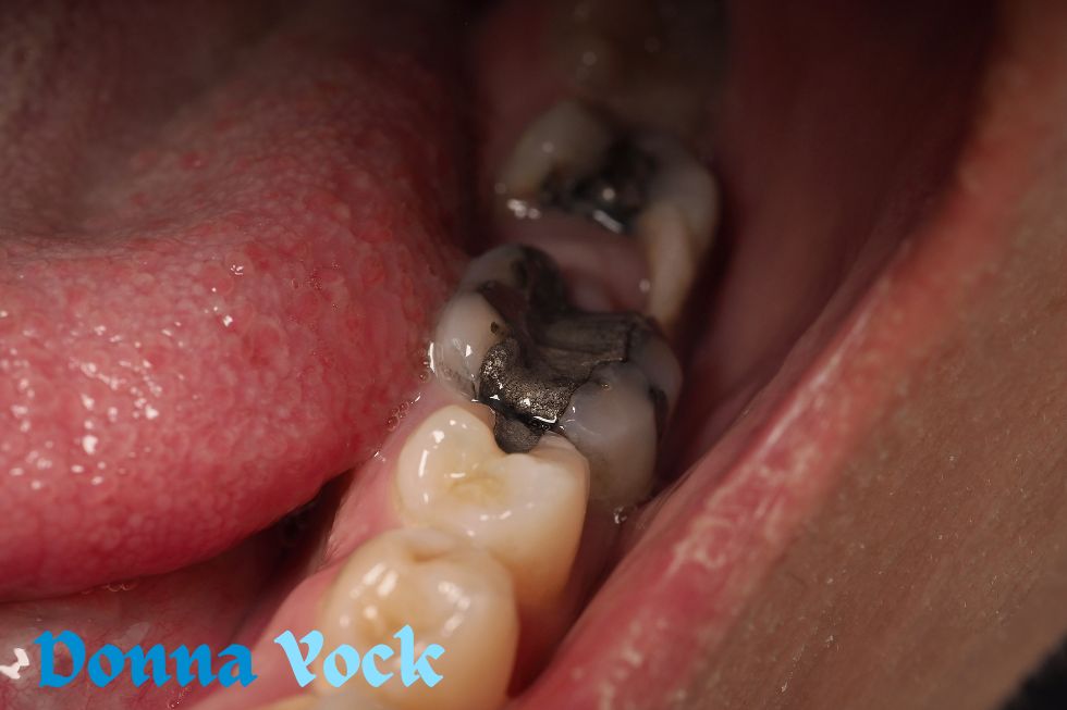 Reasons for Dental Decay