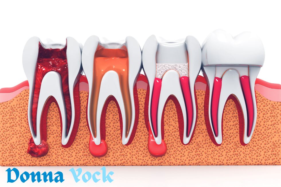 Treatment for Root Canals That Can Preserve Your Tooth