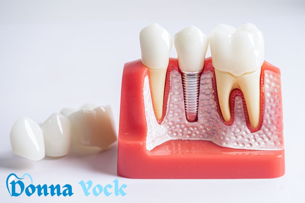 FAQs regarding root canal therapy that can preserve your tooth