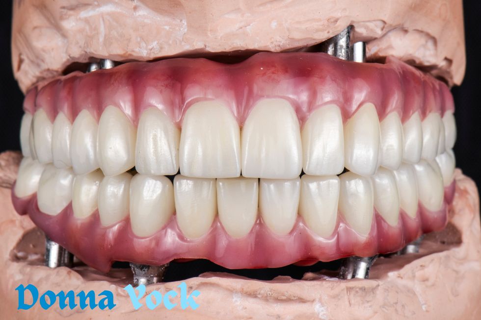 Implants with zygomatic mechanisms