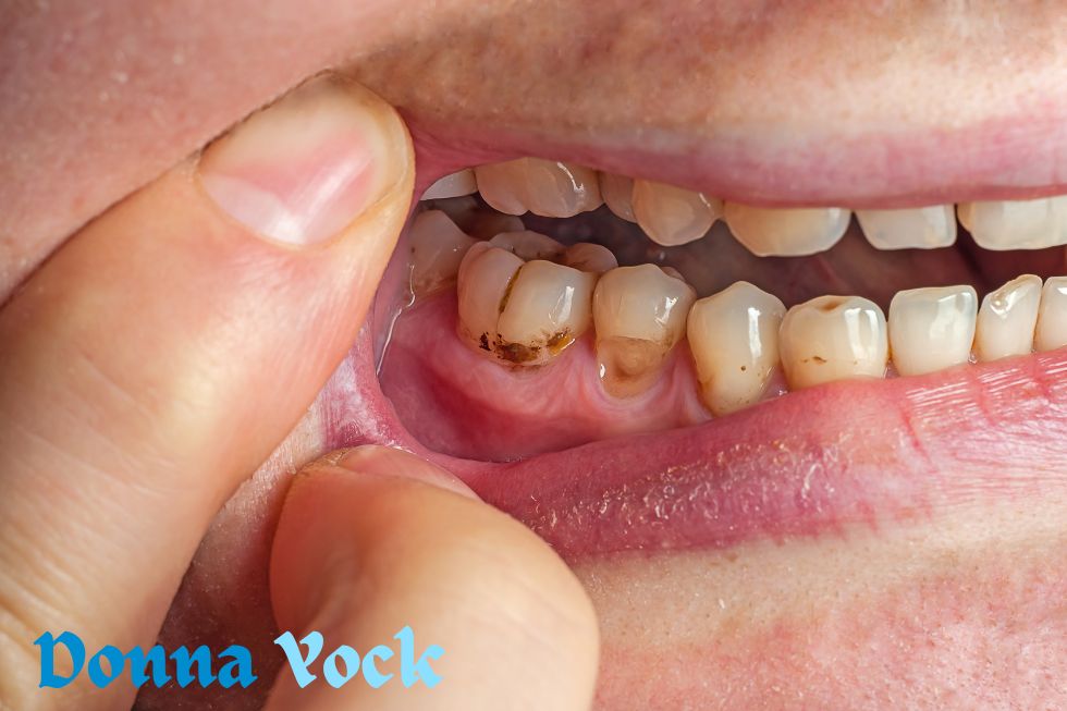Fluoride’s role in preventing dental deterioration