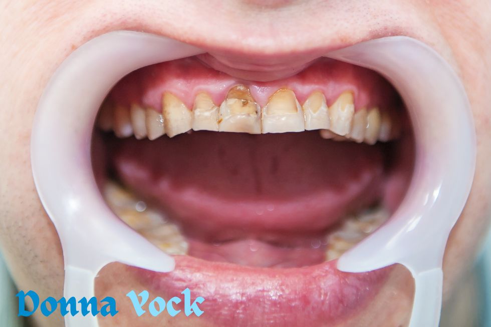Important Information Regarding Fluorosis