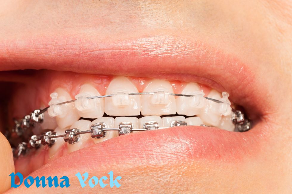 The Advantages of Adult Orthodontic Treatments