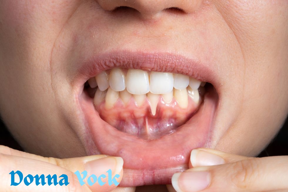 What Makes Gums Recede?