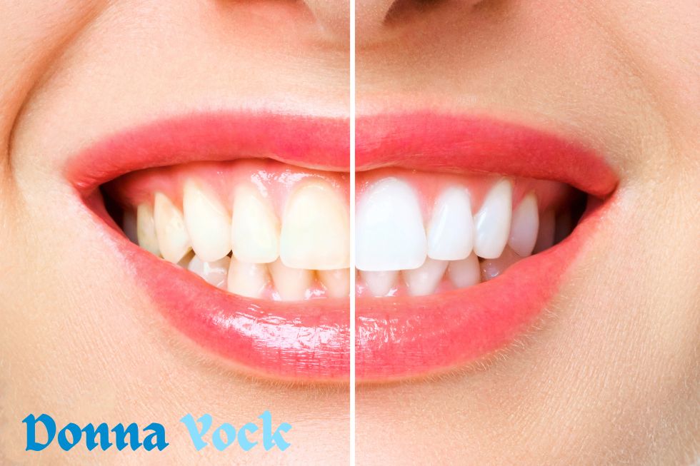 Whitening of teeth
