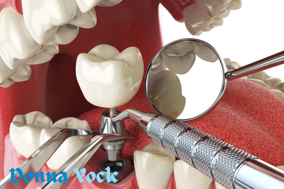 Will you actually benefit from dental implants? What do the clinical outcomes suggest, should we?
