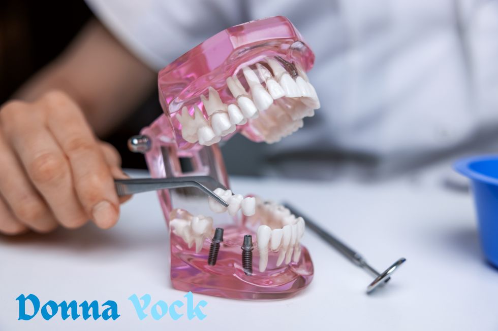 Donna Yock Dentist’s Guide to Dental Implants: Restoring Smiles