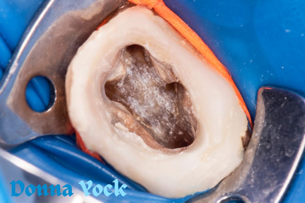 FAQs regarding root canal therapy that can save your tooth
