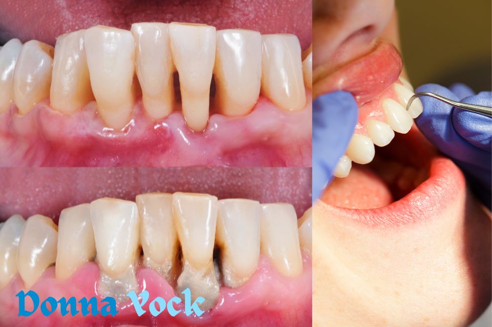 Gingivitis