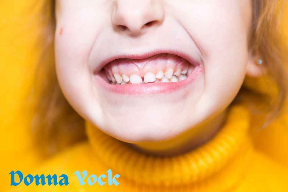 How Invisalign Can Help with Overbites: Straightening Your Smile and Correcting Your Bite
