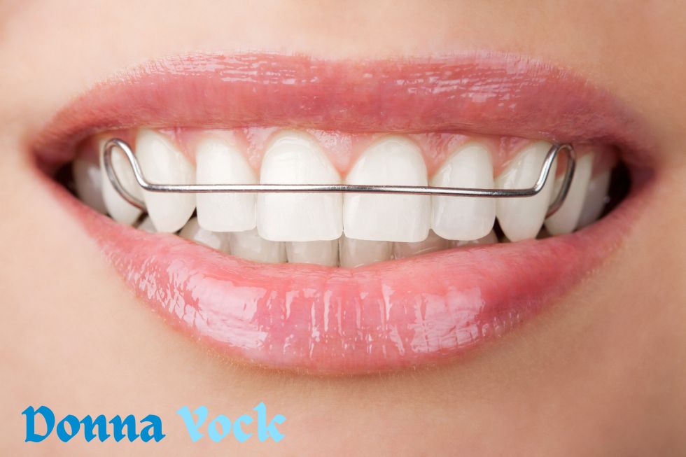 Teeth Bonding: Its Mechanism, Advantages, and More