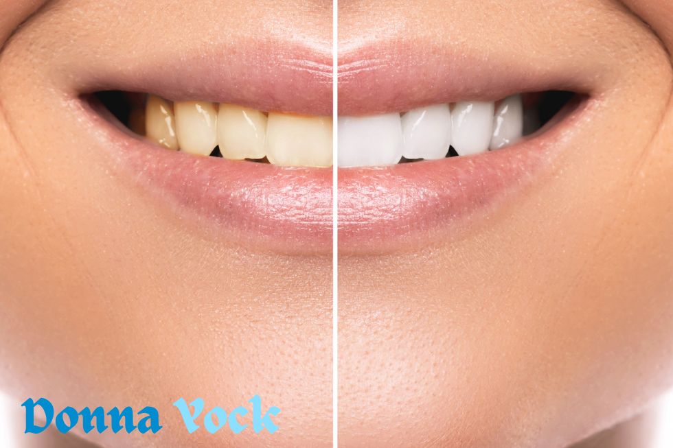 The Benefits and Mechanisms of Teeth Whitening Science