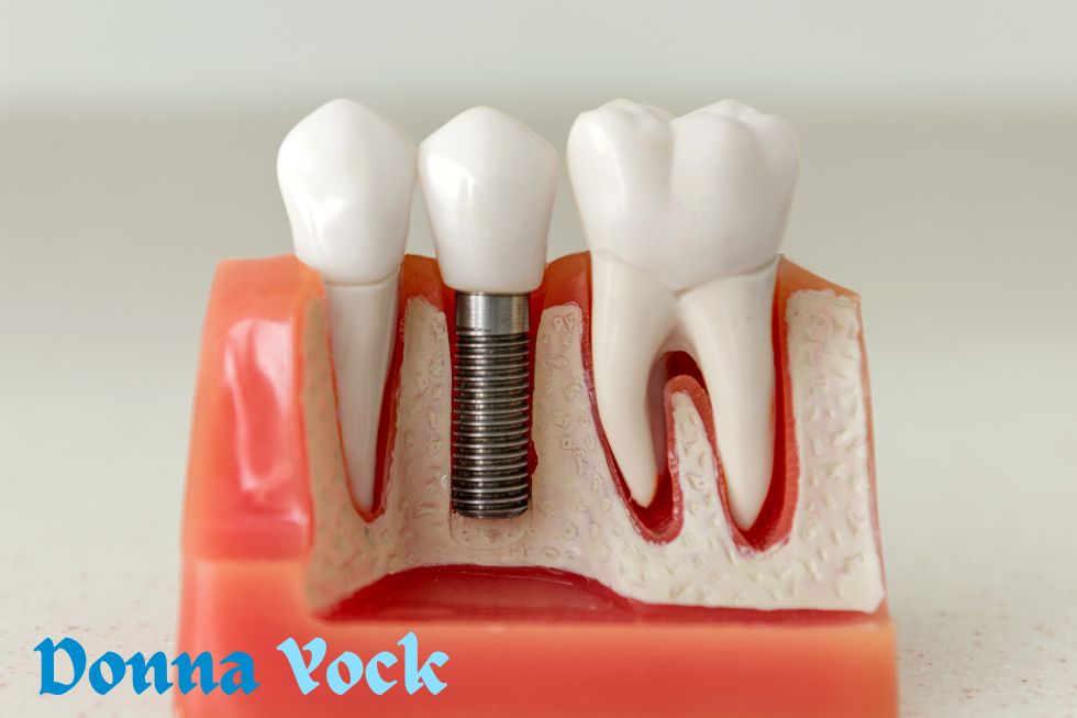 The Top 5 Things Not to Do After Getting Dental Implants